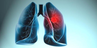 Akciğer Kanaması Bitkisel Çözüm