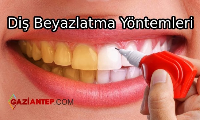 Diş Beyazlatma Yöntemleri