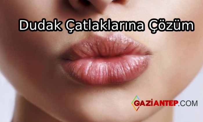 Dudak Çatlaklarına Çözüm Önerisi
