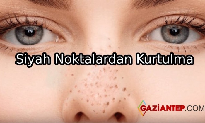 Sivilce Ve Siyah Noktalardan Kurtulma Önerileri