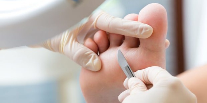 Nasır Tedavisi Hakkında Bilinmesi Gerekenler; Nasır Nedir?