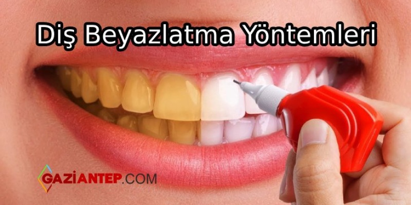 Diş Beyazlatma Yöntemleri