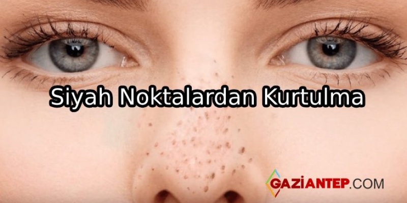 Siyah Nokta Ve Sivilcelerden Kurtulma Yolları