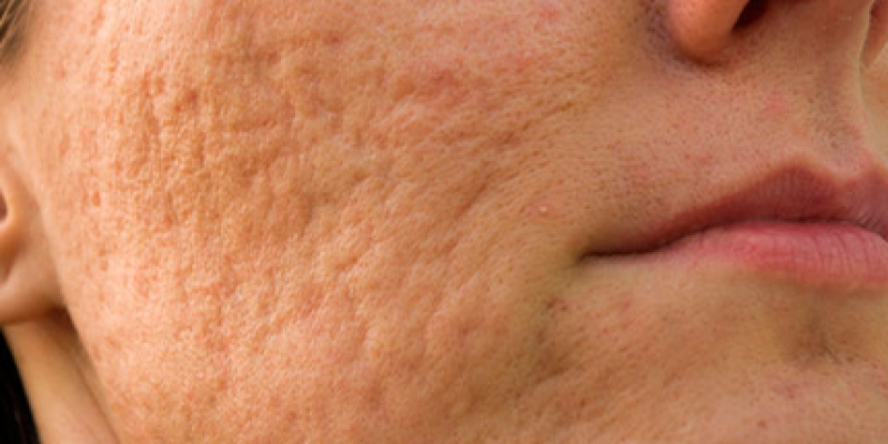 Sivilce Çukurlarına Kesin Çözüm